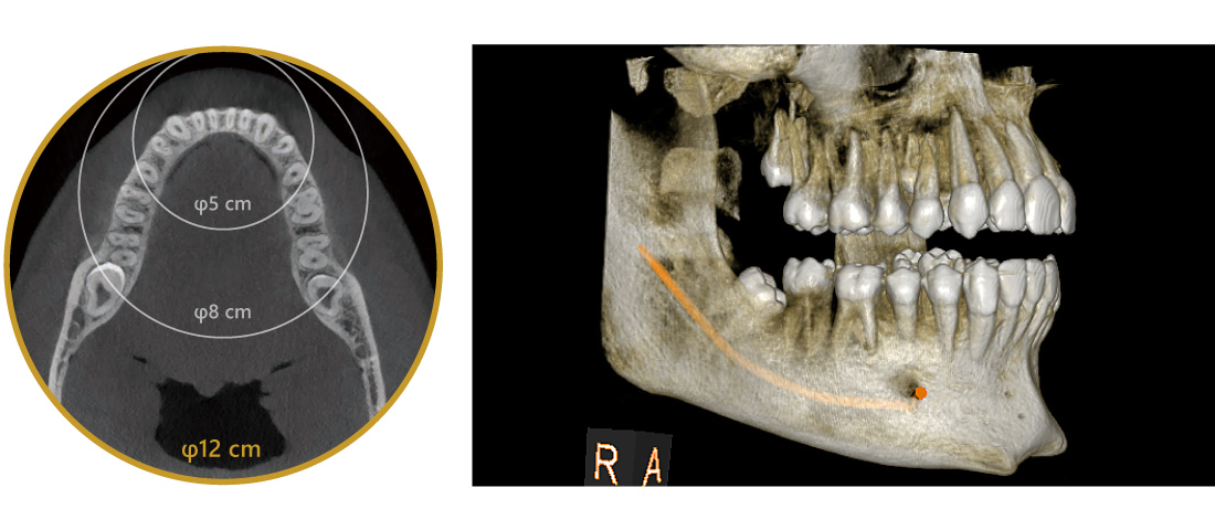 CBCT