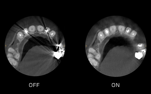 Metal Artifact Reduction Technology