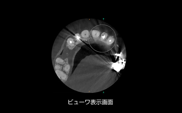 Metal Artifact Reduction Technology