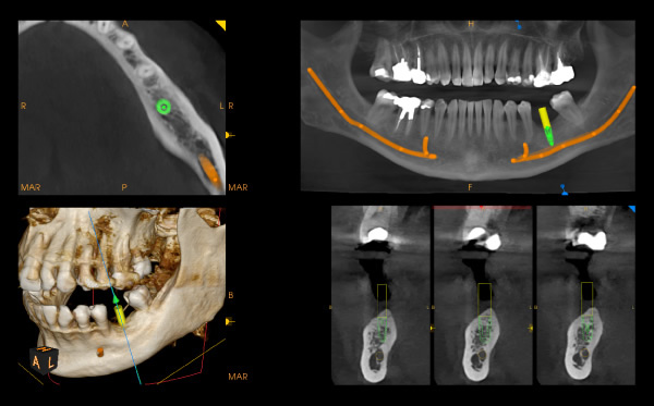 Implant simulation