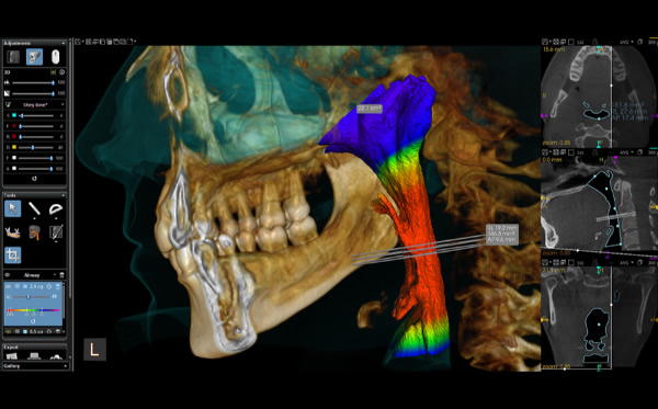 Airway