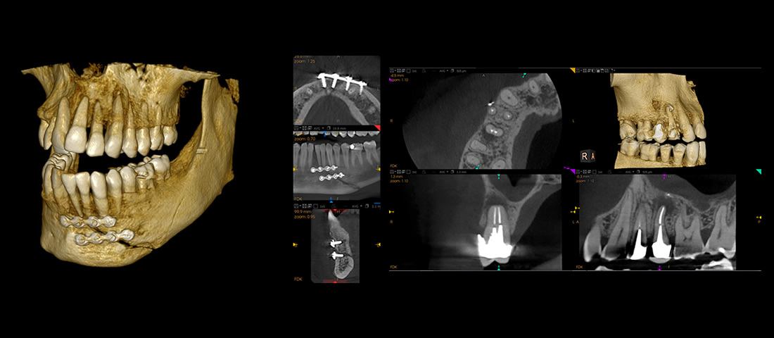 CBCT image